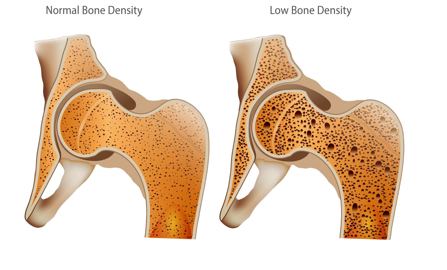 LOW BONE DENSITY Keys Of Health