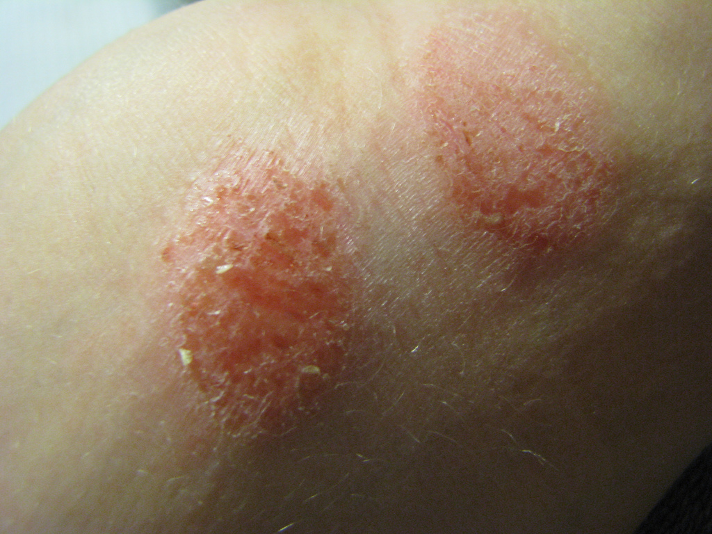 SUFFERING FROM ECZEMA? PUT AN END TO THE MISERY NOW