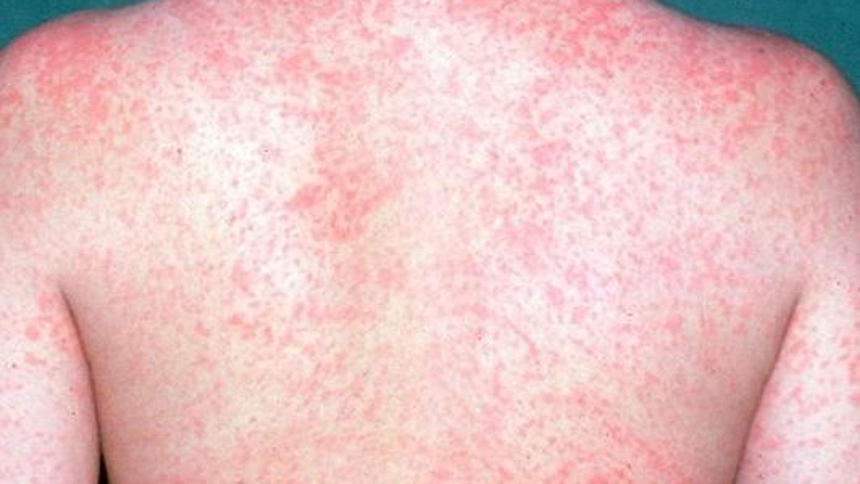 MEASLES WHAT YOU NEED TO KNOW AND DO TO OVERCOME IT