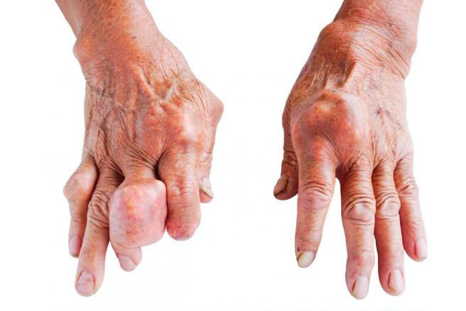 SAY GOODBYE TO GOUT!