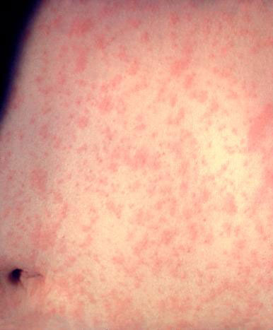 MEASLES WHAT YOU NEED TO KNOW AND DO TO OVERCOME IT